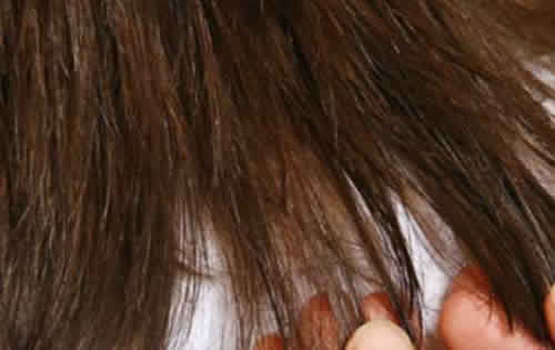 راه های جلوگیری از موخوره راه های جلوگیری از موخوره