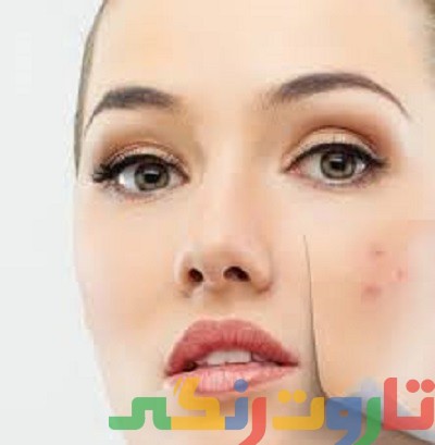 روشهای فوق العاده برای از بین بردن جای جوش روشهای فوق العاده برای از بین بردن جای جوش