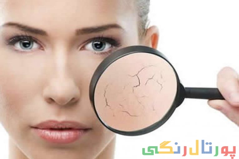 خشکی پوست