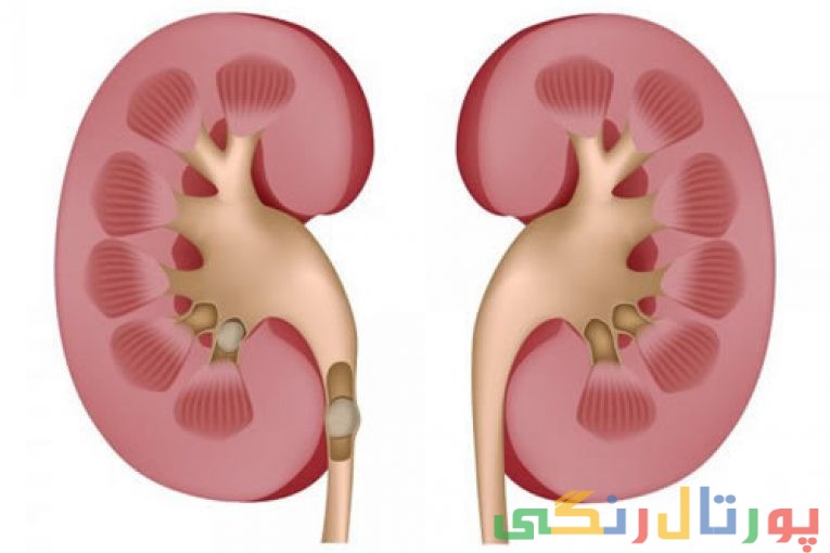 از کار افتادن کلیه