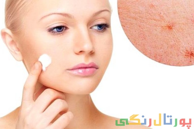جوش و آکنه,جوش و آکنه بعد از 25 سالگی,جوش و آکنه در زنان,جوش و آکنه در مردان,جوش و آکنه نوجوانی,درمان جوش و آکنه