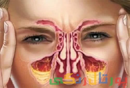 آلرژی می تواند سبب بروز پولیپ بینی و سینوزیت شود آلرژی می تواند سبب بروز پولیپ بینی و سینوزیت شود