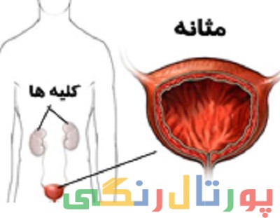 دلایل تکرر ادرار و عفونت مثانه چیست؟ دلایل تکرر ادرار و عفونت مثانه چیست؟