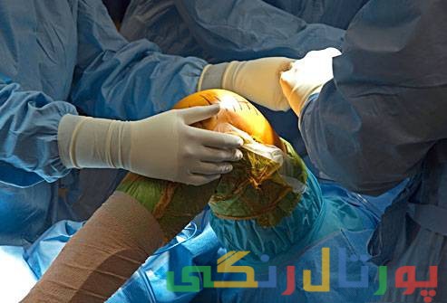 اطلاعات کامل درباره تعویض مفصل زانو 