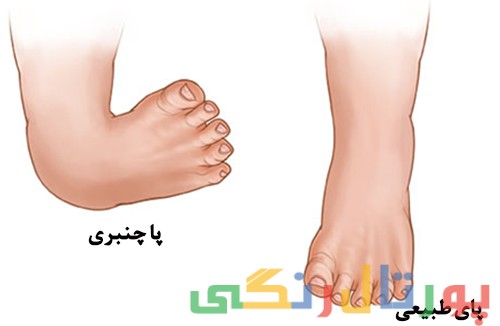 در مورد بیماری مادرزادی پاچنبری بیشتر بدانید در مورد بیماری مادرزادی پاچنبری بیشتر بدانید