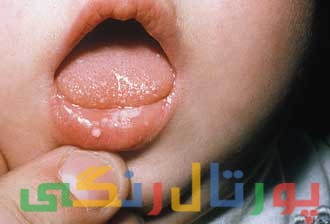 برفک دهان نوزاد + دلایل و راه درمان برفک دهان نوزاد + دلایل و راه درمان