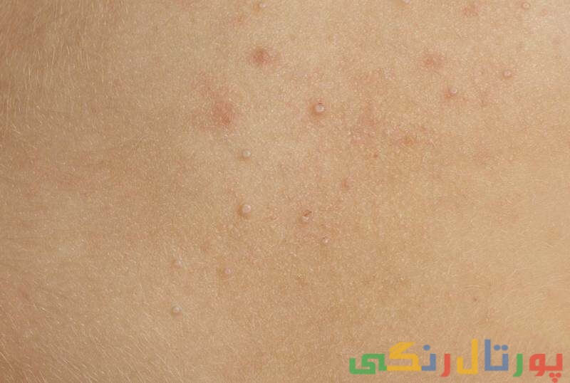 لکه های سفید روی پوست ختنه گاه ناحیه تناسلی نشانه چیست؟